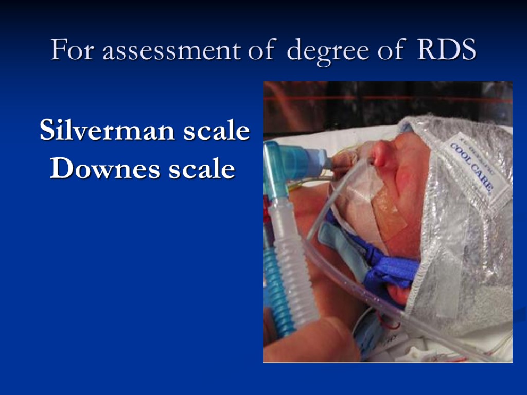 For assessment of degree of RDS Silverman scale Downes scale